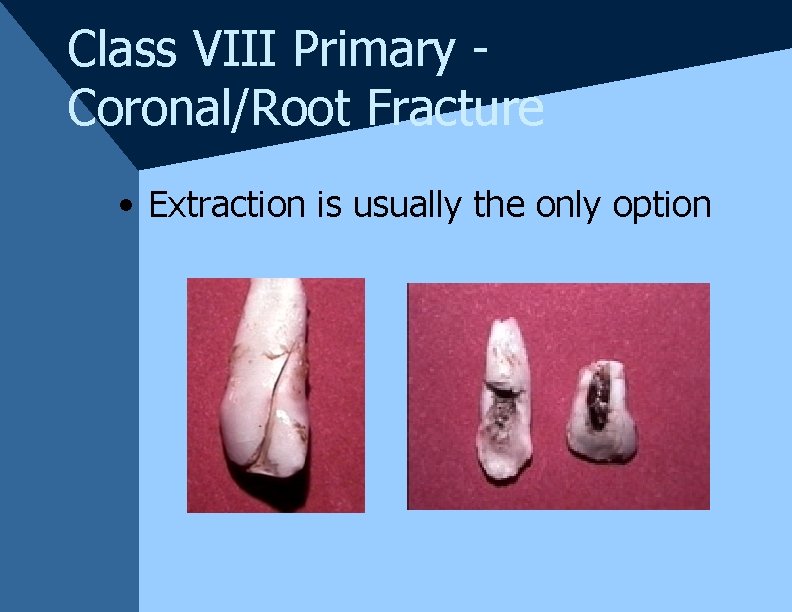 Class VIII Primary Coronal/Root Fracture • Extraction is usually the only option Class VIII Primary Coronal/Root Fracture • Extraction is usually the only option