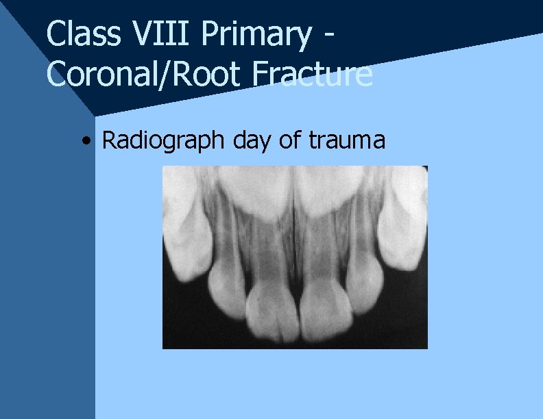 Class VIII Primary Coronal/Root Fracture • Radiograph day of trauma Class VIII Primary Coronal/Root Fracture • Radiograph day of trauma
