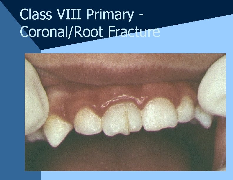 Class VIII Primary Coronal/Root Fracture Class VIII Primary Coronal/Root Fracture