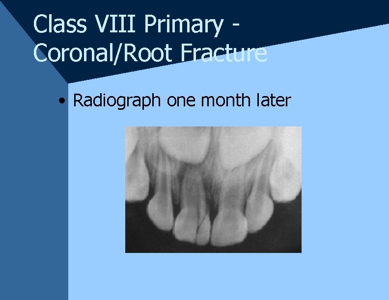 Class VIII Primary Coronal/Root Fracture • Radiograph one month later Class VIII Primary Coronal/Root Fracture • Radiograph one month later