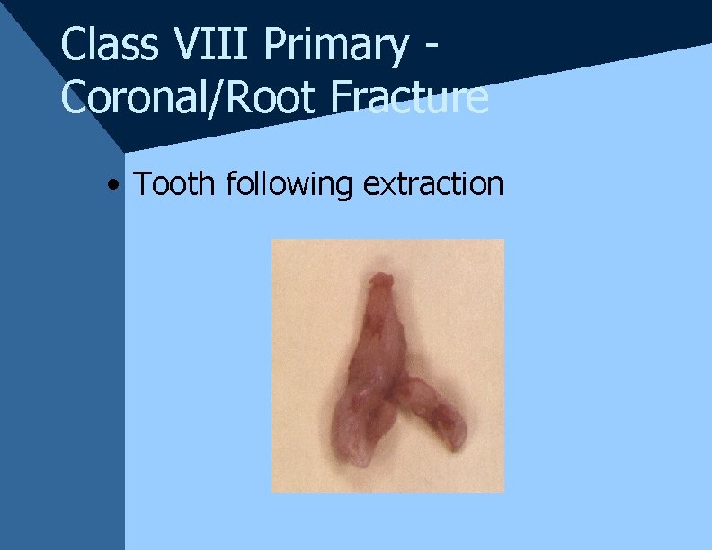 Class VIII Primary Coronal/Root Fracture • Tooth following extraction Class VIII Primary Coronal/Root Fracture • Tooth following extraction