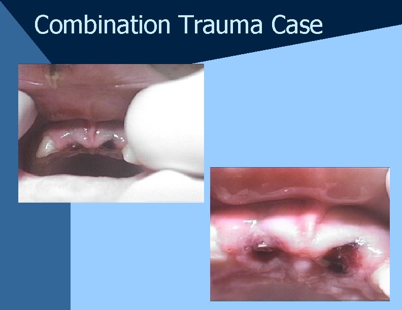 Combination Trauma Case Combination Trauma Case