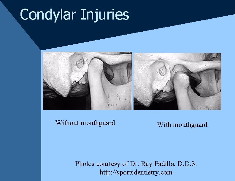 Condylar Injuries Without mouthguard With mouthguard Photos courtesy of Dr. Ray Padilla, D. D. Condylar Injuries Without mouthguard With mouthguard Photos courtesy of Dr. Ray Padilla, D. D.