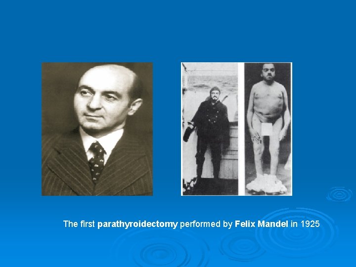 The first parathyroidectomy performed by Felix Mandel in 1925 