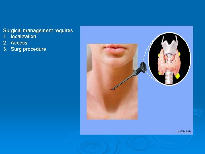 Surgical management requires 1. localization 2. Access 3. Surg procedure 