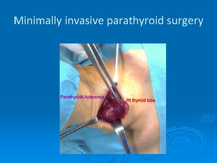 Minimally invasive parathyroid surgery 