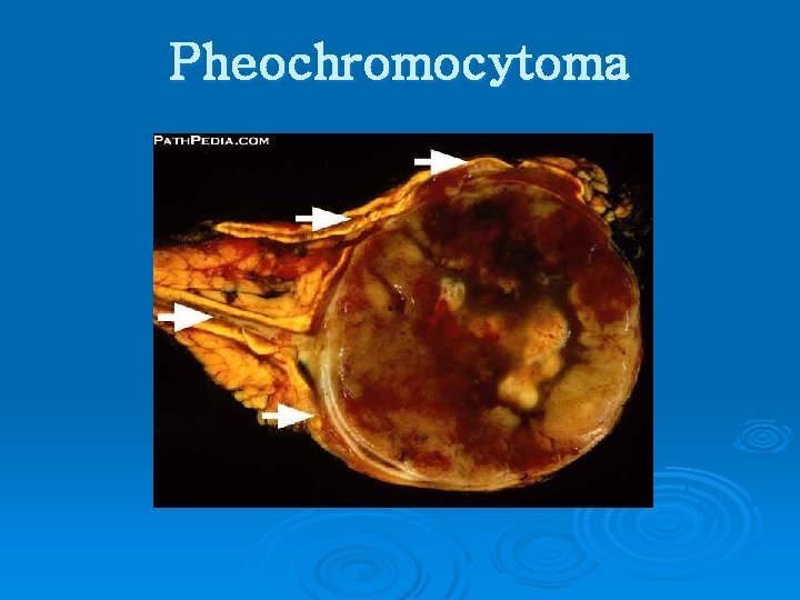 Pheochromocytoma 