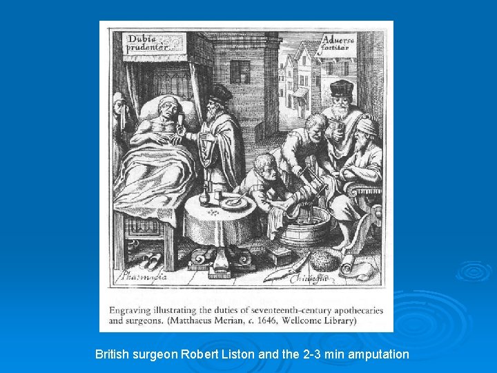 British surgeon Robert Liston and the 2 -3 min amputation 