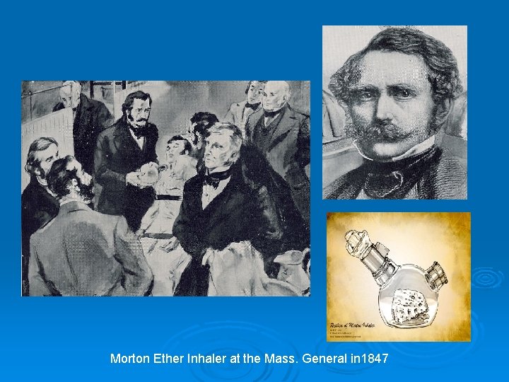 Morton Ether Inhaler at the Mass. General in 1847 