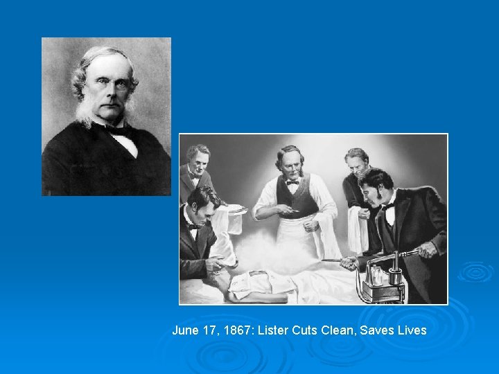 June 17, 1867: Lister Cuts Clean, Saves Lives 