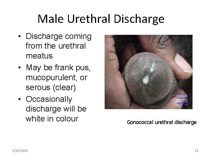 Male Urethral Discharge • Discharge coming from the urethral meatus • May be frank