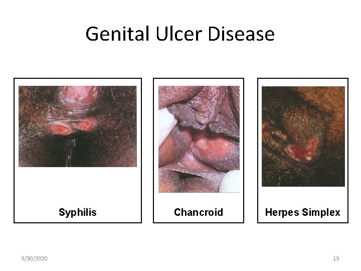 Genital Ulcer Disease Syphilis 9/30/2020 Chancroid Herpes Simplex 19 