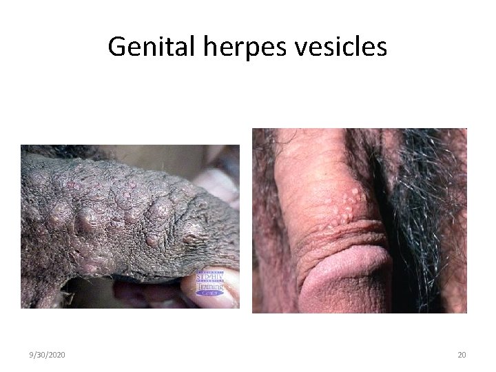 Genital herpes vesicles 9/30/2020 20 