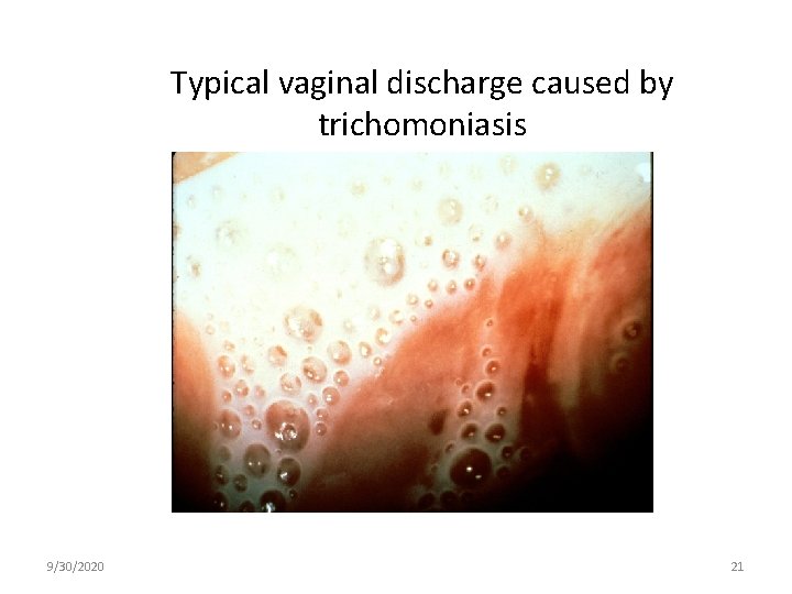 Typical vaginal discharge caused by trichomoniasis 9/30/2020 21 