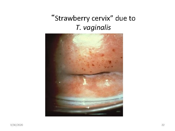 “Strawberry cervix” due to T. vaginalis 9/30/2020 22 