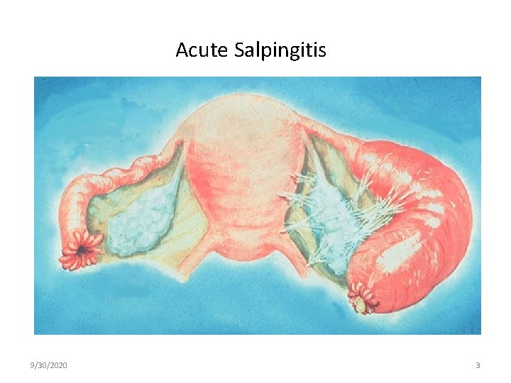 Acute Salpingitis 9/30/2020 3 