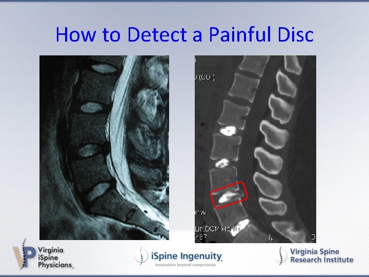 How to Detect a Painful Disc 