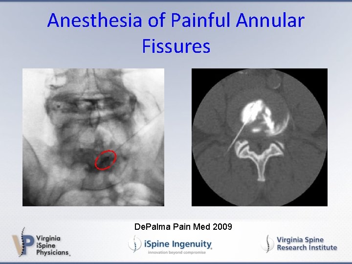 Anesthesia of Painful Annular Fissures De. Palma Pain Med 2009 