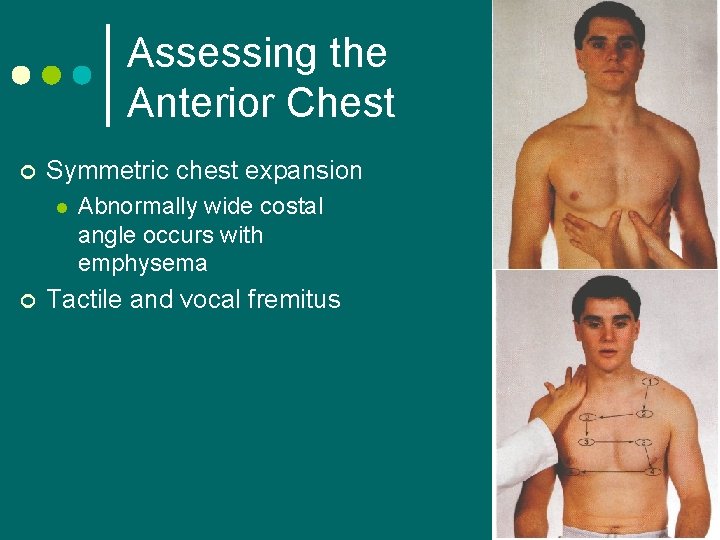 Assessing the Anterior Chest ¢ Symmetric chest expansion l ¢ Abnormally wide costal angle