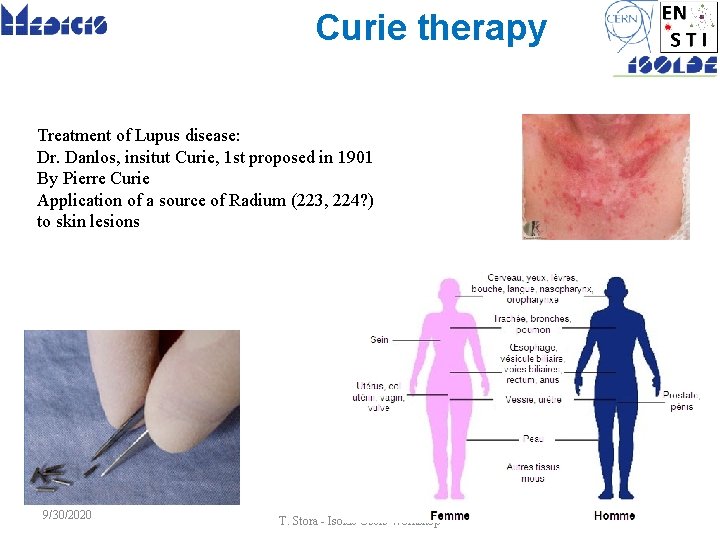 Curie therapy Treatment of Lupus disease: Dr. Danlos, insitut Curie, 1 st proposed in