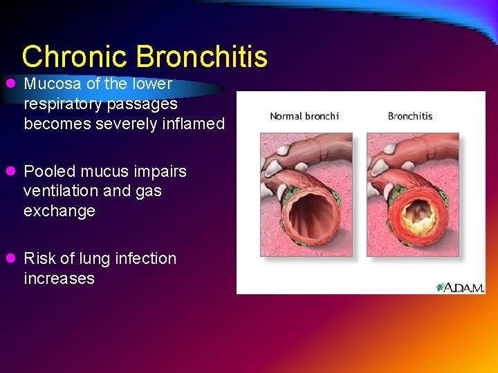 Chronic Bronchitis l Mucosa of the lower respiratory passages becomes severely inflamed l Pooled