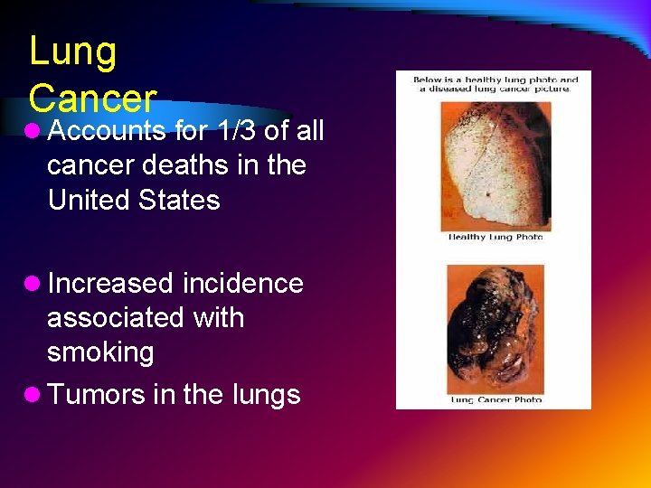 Lung Cancer l Accounts for 1/3 of all cancer deaths in the United States