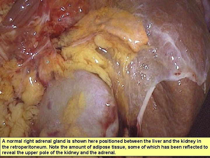 A normal right adrenal gland is shown here positioned between the liver and the