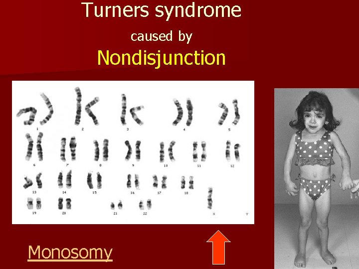 Turners syndrome caused by Nondisjunction Monosomy 