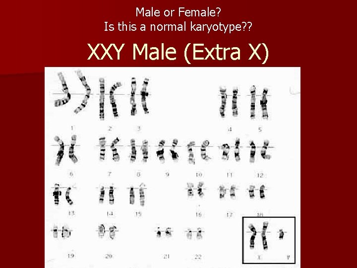 Male or Female? Is this a normal karyotype? ? XXY Male (Extra X) 