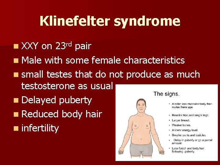 Klinefelter syndrome n XXY on 23 rd pair n Male with some female characteristics