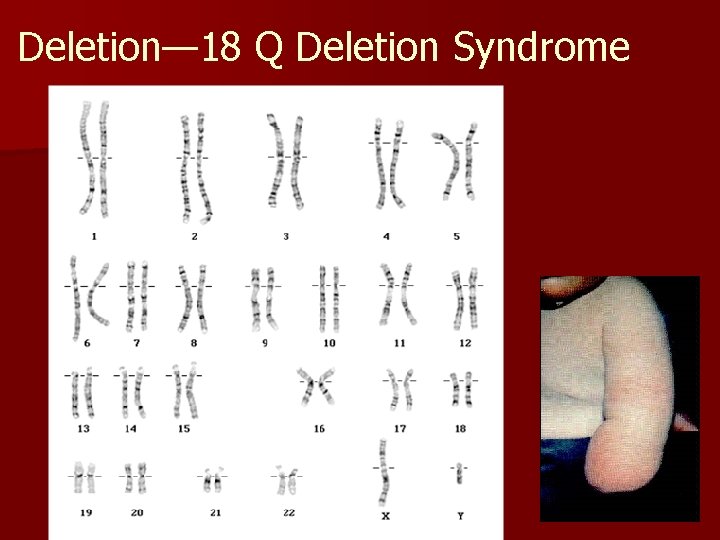 Deletion— 18 Q Deletion Syndrome 