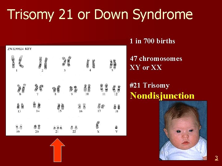 Trisomy 21 or Down Syndrome 1 in 700 births 47 chromosomes XY or XX