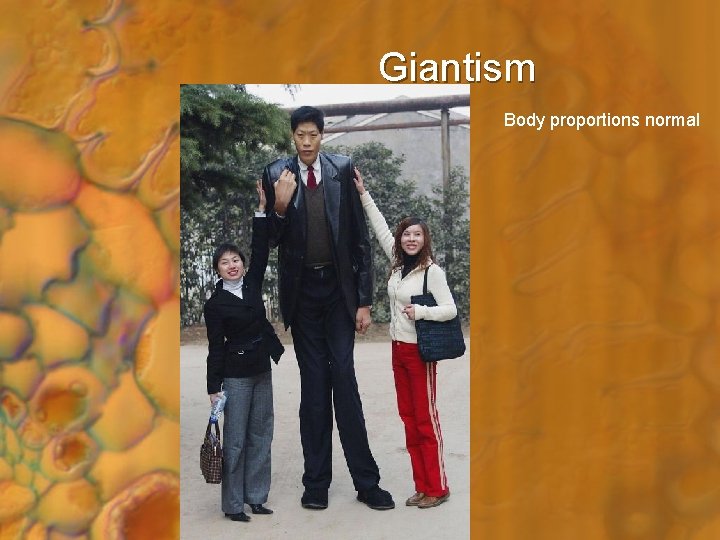 Giantism Body proportions normal 