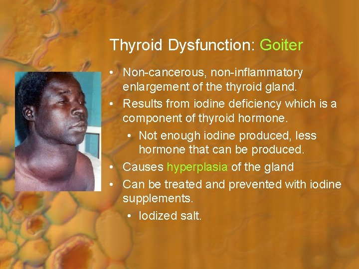 Thyroid Dysfunction: Goiter • Non-cancerous, non-inflammatory enlargement of the thyroid gland. • Results from