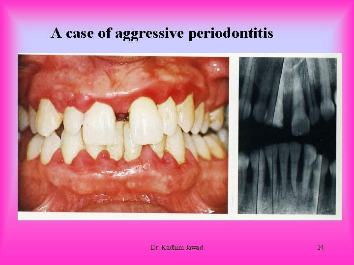 A case of aggressive periodontitis Dr. Kadhim Jawad 24 