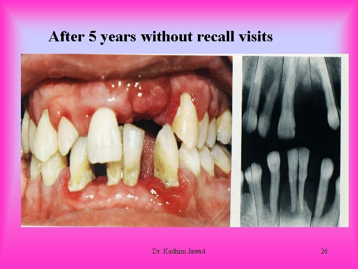 After 5 years without recall visits Dr. Kadhim Jawad 26 