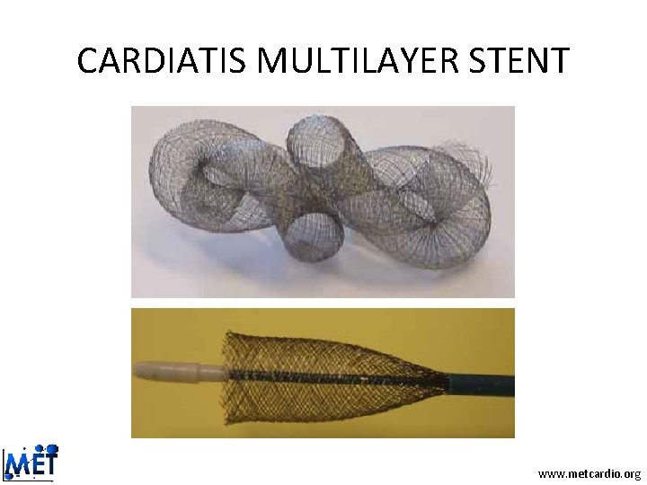 CARDIATIS MULTILAYER STENT www. metcardio. org CARDIATIS MULTILAYER STENT www. metcardio. org