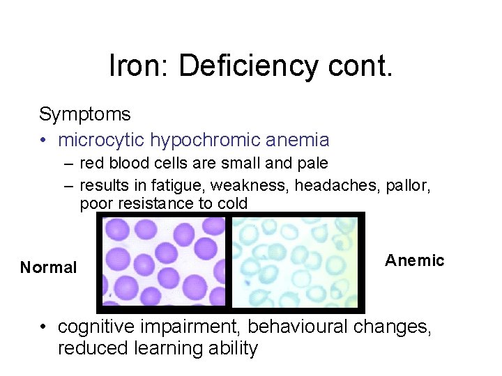 Iron: Deficiency cont. Symptoms • microcytic hypochromic anemia – red blood cells are small Iron: Deficiency cont. Symptoms • microcytic hypochromic anemia – red blood cells are small