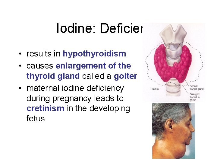 Iodine: Deficiency • results in hypothyroidism • causes enlargement of the thyroid gland called Iodine: Deficiency • results in hypothyroidism • causes enlargement of the thyroid gland called