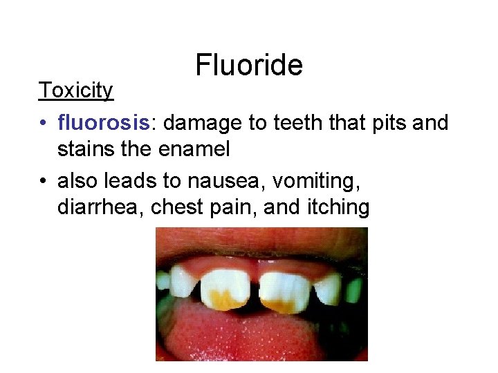 Fluoride Toxicity • fluorosis: damage to teeth that pits and stains the enamel • Fluoride Toxicity • fluorosis: damage to teeth that pits and stains the enamel •