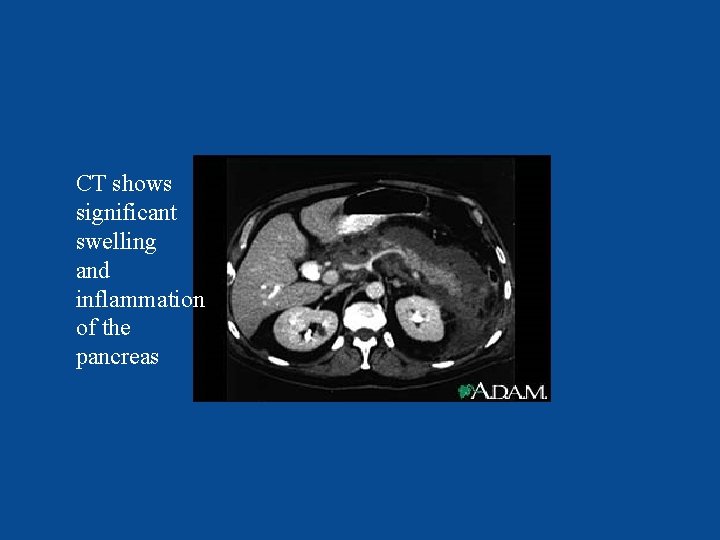 CT shows significant swelling and inflammation of the pancreas CT shows significant swelling and inflammation of the pancreas