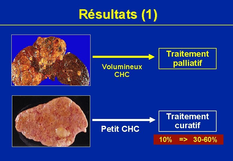 Résultats (1) Volumineux CHC Petit CHC Traitement palliatif Traitement curatif 10% => 30 -60%