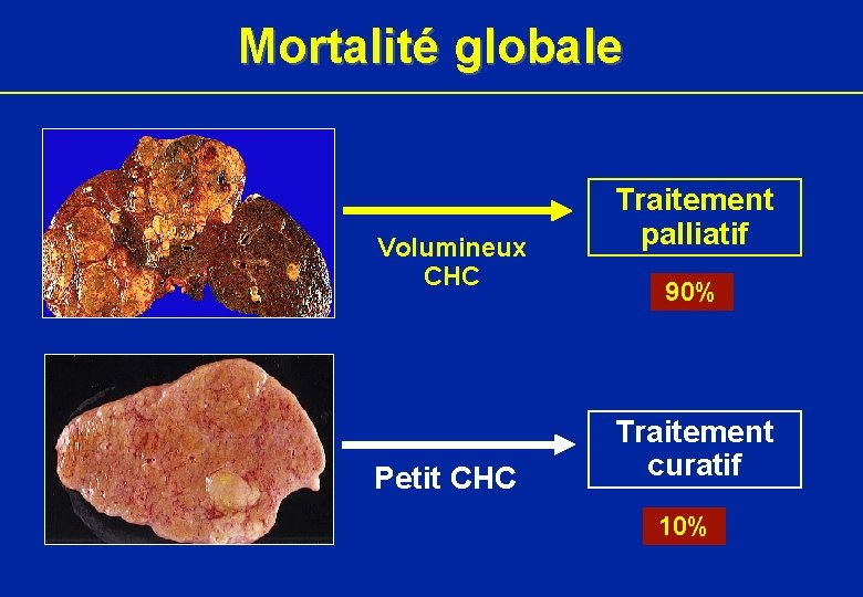 Mortalité globale Volumineux CHC Petit CHC Traitement palliatif 90% Traitement curatif 10% 