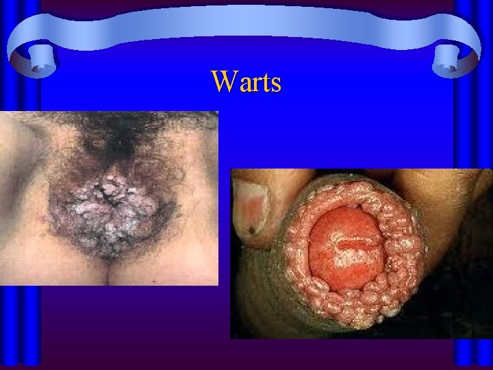 Warts 