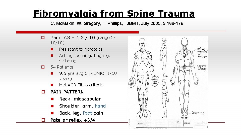 Fibromyalgia from Spine Trauma C. Mc. Makin, W. Gregory, T. Phillips, JBMT, July 2005,