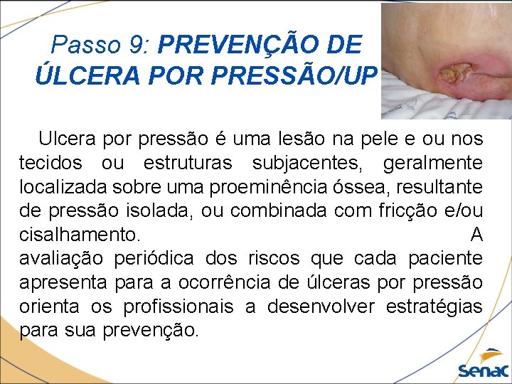 Passo 9: PREVENÇÃO DE ÚLCERA POR PRESSÃO/UP Ulcera por pressão é uma lesão na