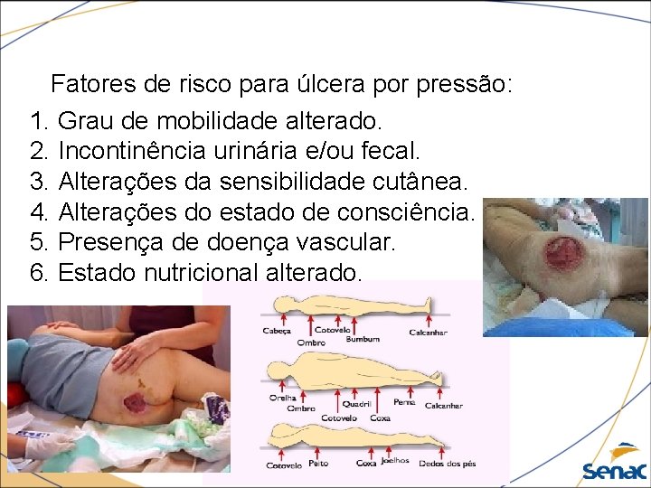 Fatores de risco para úlcera por pressão: 1. Grau de mobilidade alterado. 2. Incontinência