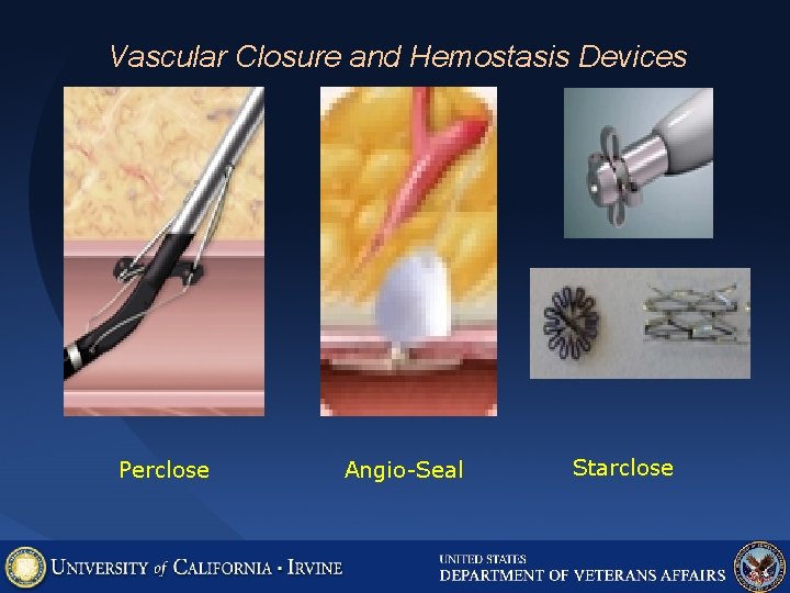 Vascular Closure and Hemostasis Devices Perclose Angio-Seal Starclose 