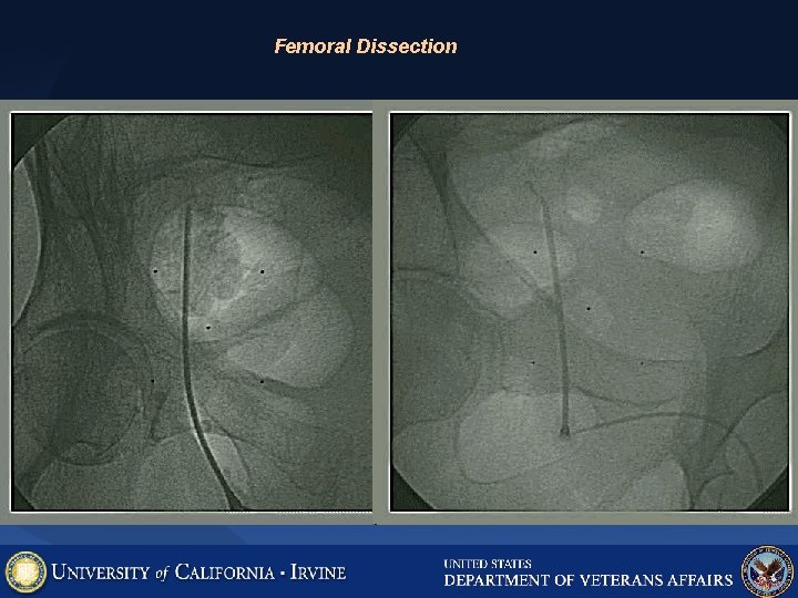 Femoral Dissection 