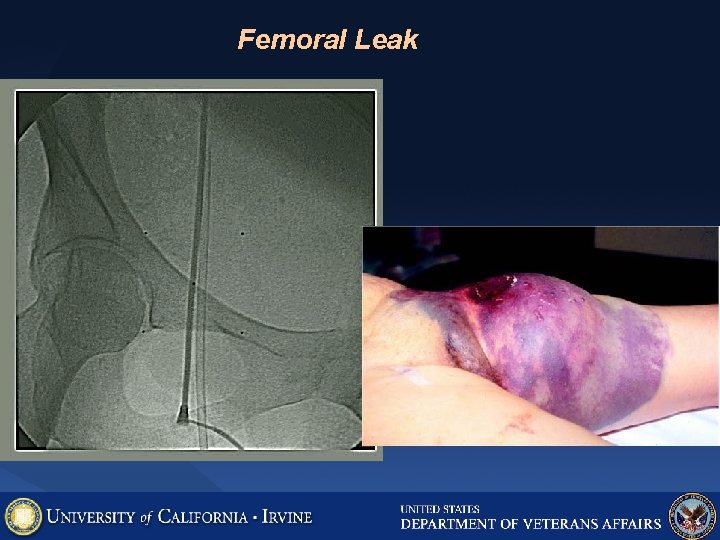 Femoral Leak Femoral Leak